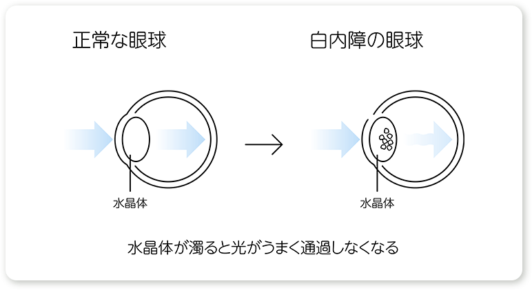 正常な眼球と白内障の眼球図