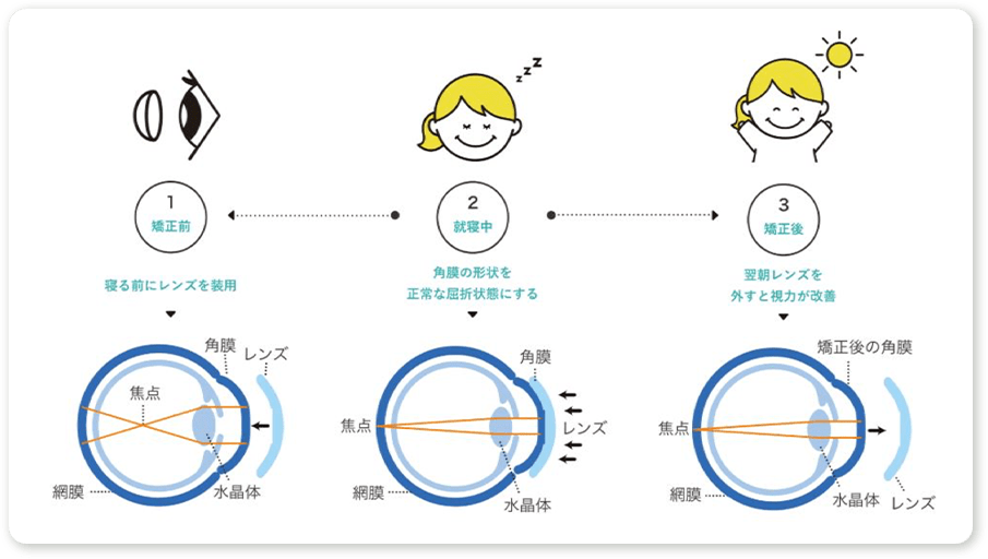 オルソケラトロジーについて