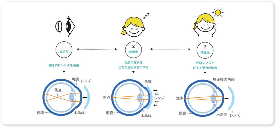 オルソケラトロジーについて