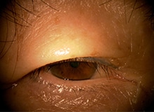 施術事例目元の画像