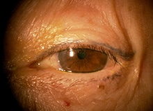 施術事例目元の画像