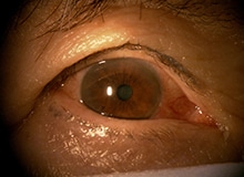 施術事例目元の画像