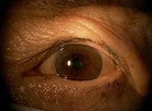 施術事例目元の画像