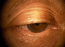 施術事例目元の画像