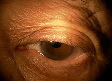 施術事例目元の画像