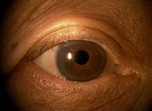 施術事例目元の画像