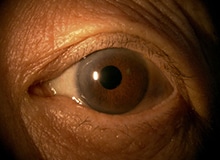 施術事例目元の画像