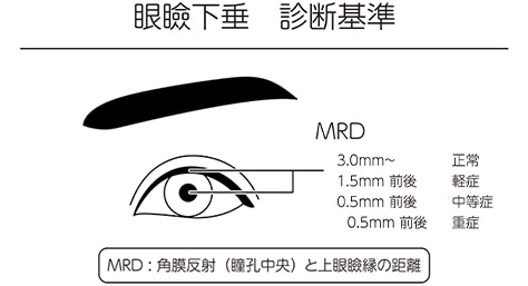 眼瞼下垂基準