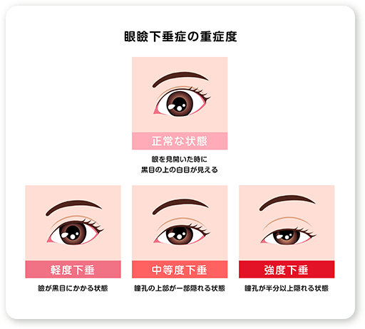 眼瞼下垂の重症度、軽度から強度イメージ図